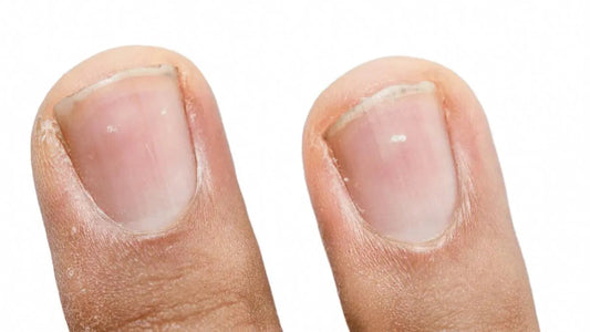 White Spots on Nails - Classic Derma