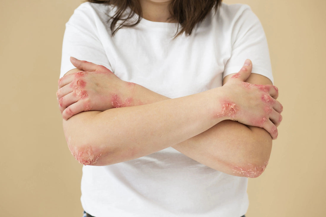 Differentiating Hives and Rashes: Identifying Key Distinctions - Classic Derma