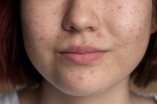 Does Eating Eggs Cause Pimples? What Science Says About Eggs and Acne - Classic Derma