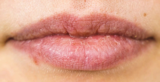 Get Rid of Pimple on Lip: Tips and Tricks - Classic Derma