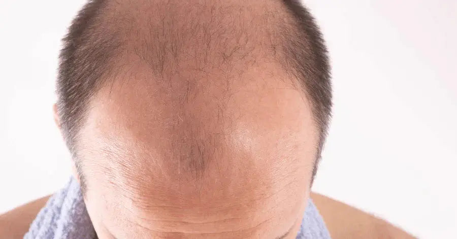 Reclaiming Your Confidence: A Guide to Conquering Male Pattern Baldness - Classic Derma