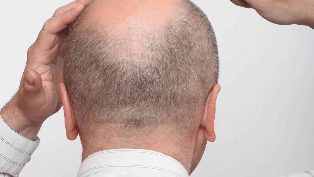 Unraveling the Mystery of Alopecia Areata: A Comprehensive Guide - Classic Derma